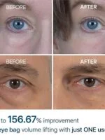 کرم دور چشم درمان پف و تیرگی دکتر ملاکسینDr.Melaxin Eyephalt Eyebag Cream - تصویر 5
